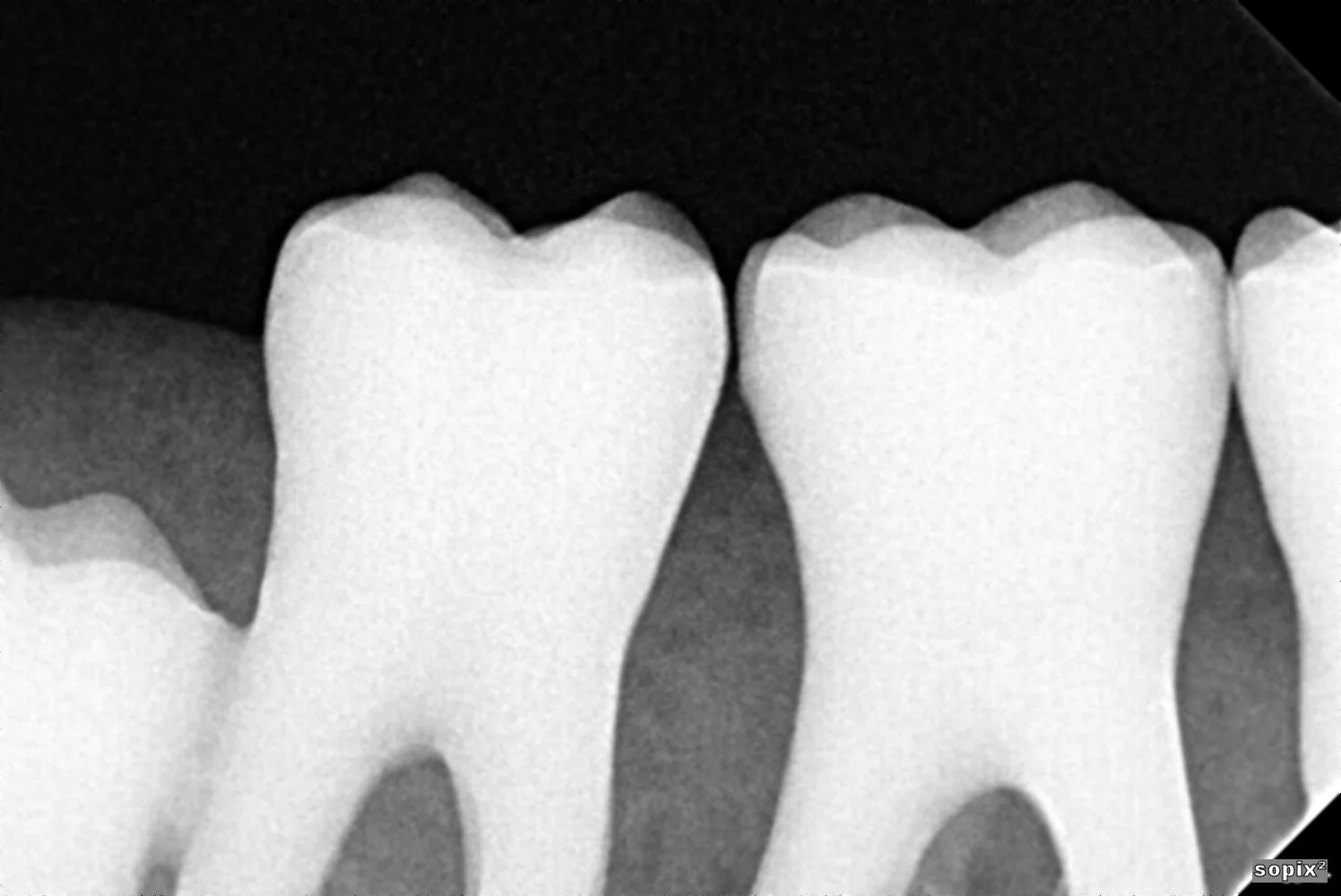 Acteon SoPix 2 Dental Intraoral X-Ray Sensor Size 1 - Image 3